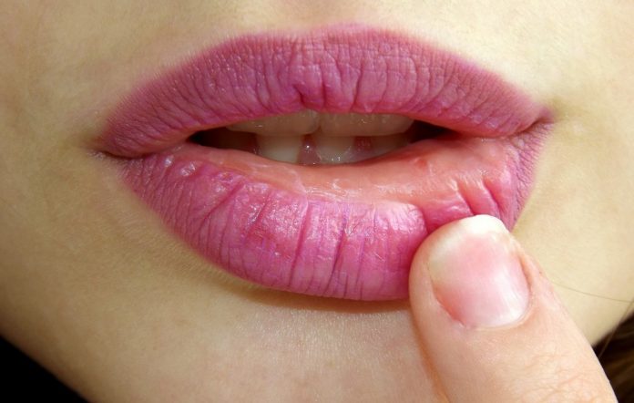 6 dicas para tratar as rachaduras nos lábios