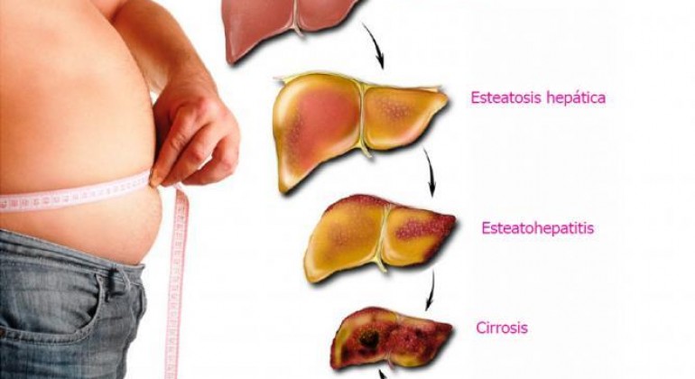 Gordura no Fígado! Como tratar?