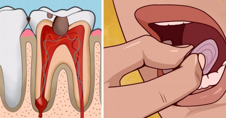 10 Remédios Caseiros Para Dor de Dente!