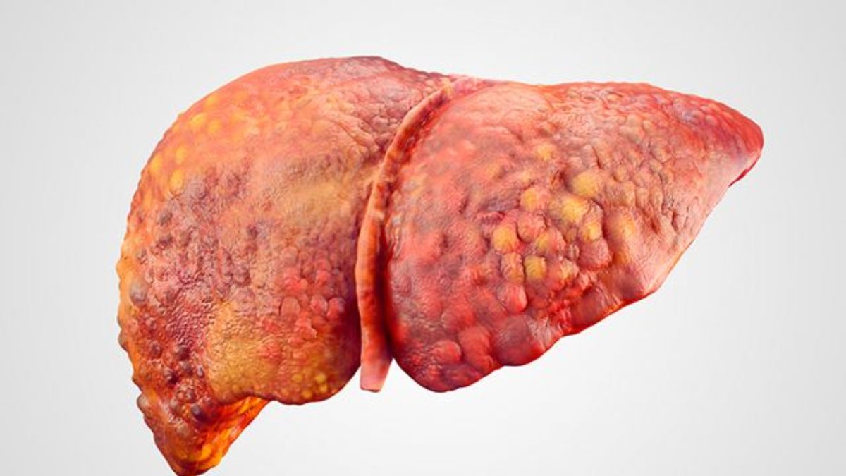 Doença perigosa, acúmulo de gordura no fígado está relacionado ao estilo de vida